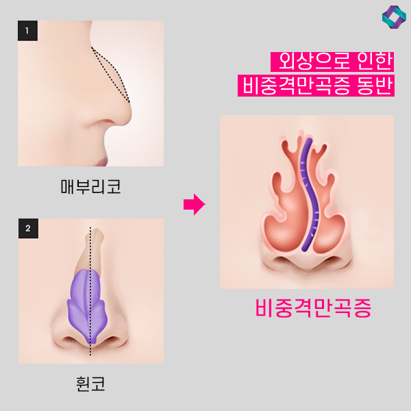기능코성형 비중격만곡증(비중격교정술)과 코막힘원인 관련 이미지 4