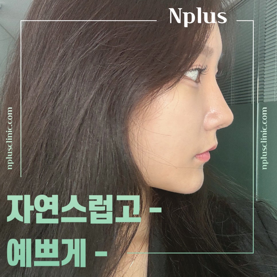 Check the Difference in Autologous Rib Nose Surgery Results image 12