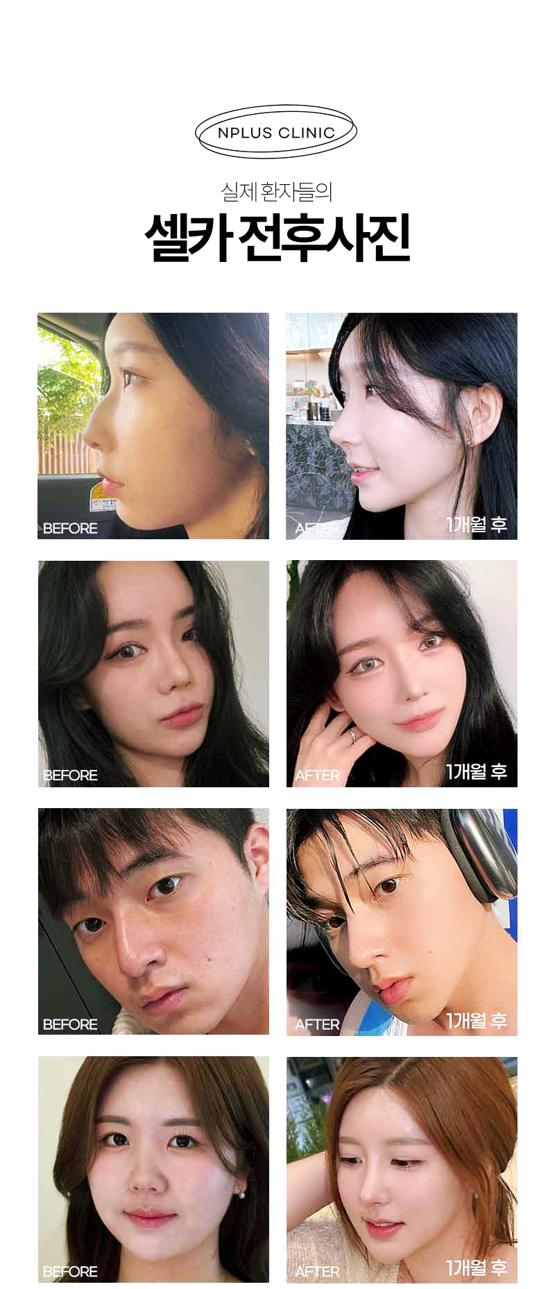 앤플러스 자가늑코성형은 예쁘다! 관련 이미지 2
