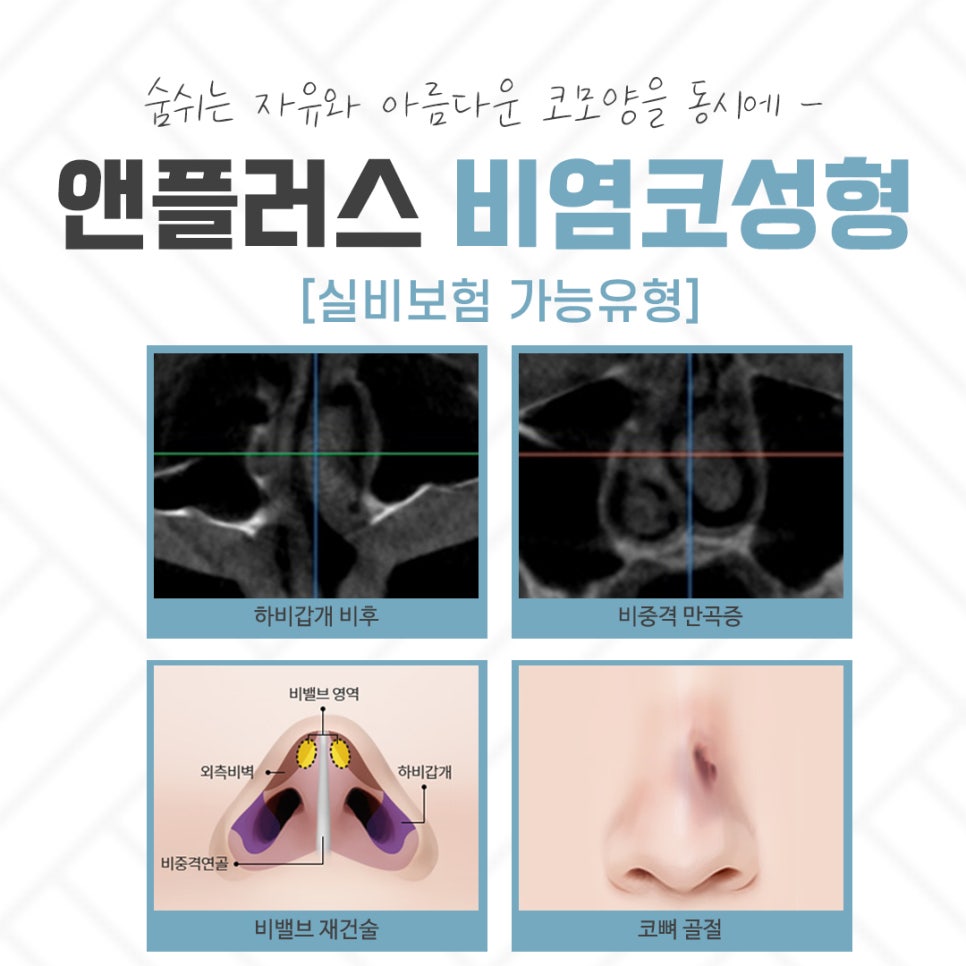 If You Are Checking Reviews of Rhinitis Nose Surgery image 5