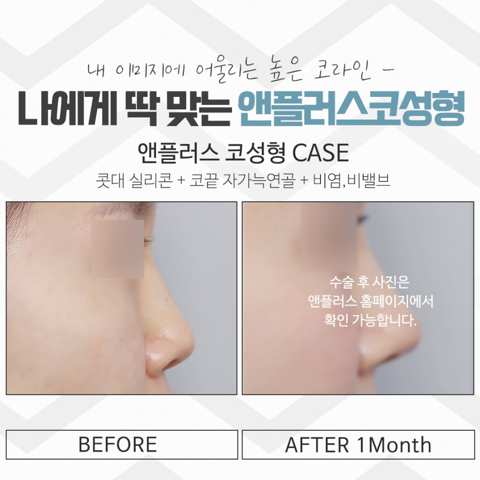 Rhinoplasty Review: Improved with a Refined Line image 17