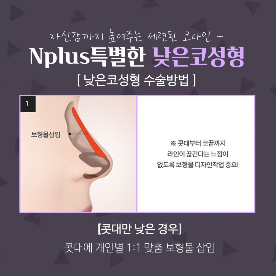 낮은코수술후기 세련된 코라인으로 관련 이미지 10