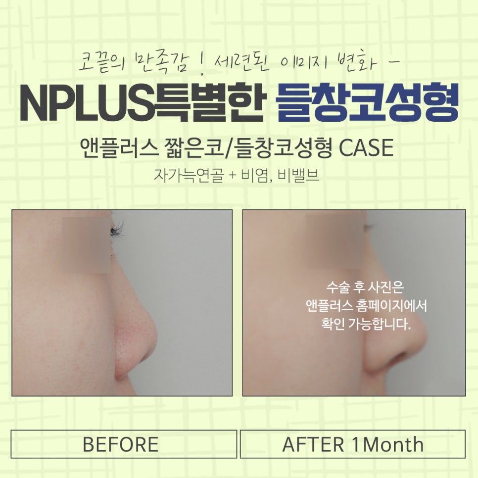 Significantly Improve an Upturned Nose with Surgery image 16