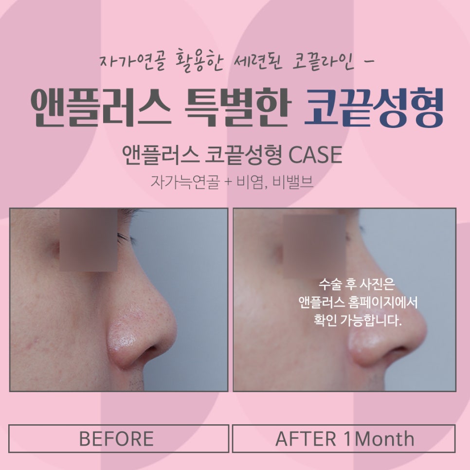 코끝처짐 개선한 코끝성형후기 관련 이미지 15