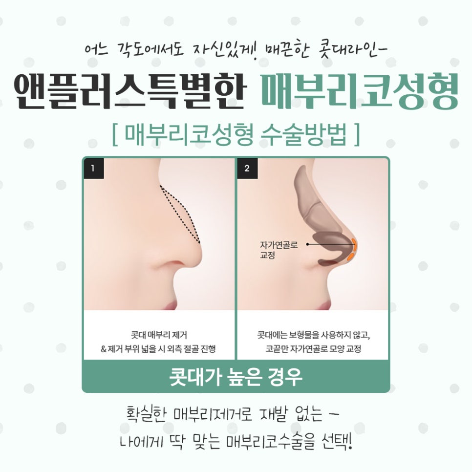 매부리코성형후기 코끝처짐을 개선하여 관련 이미지 9
