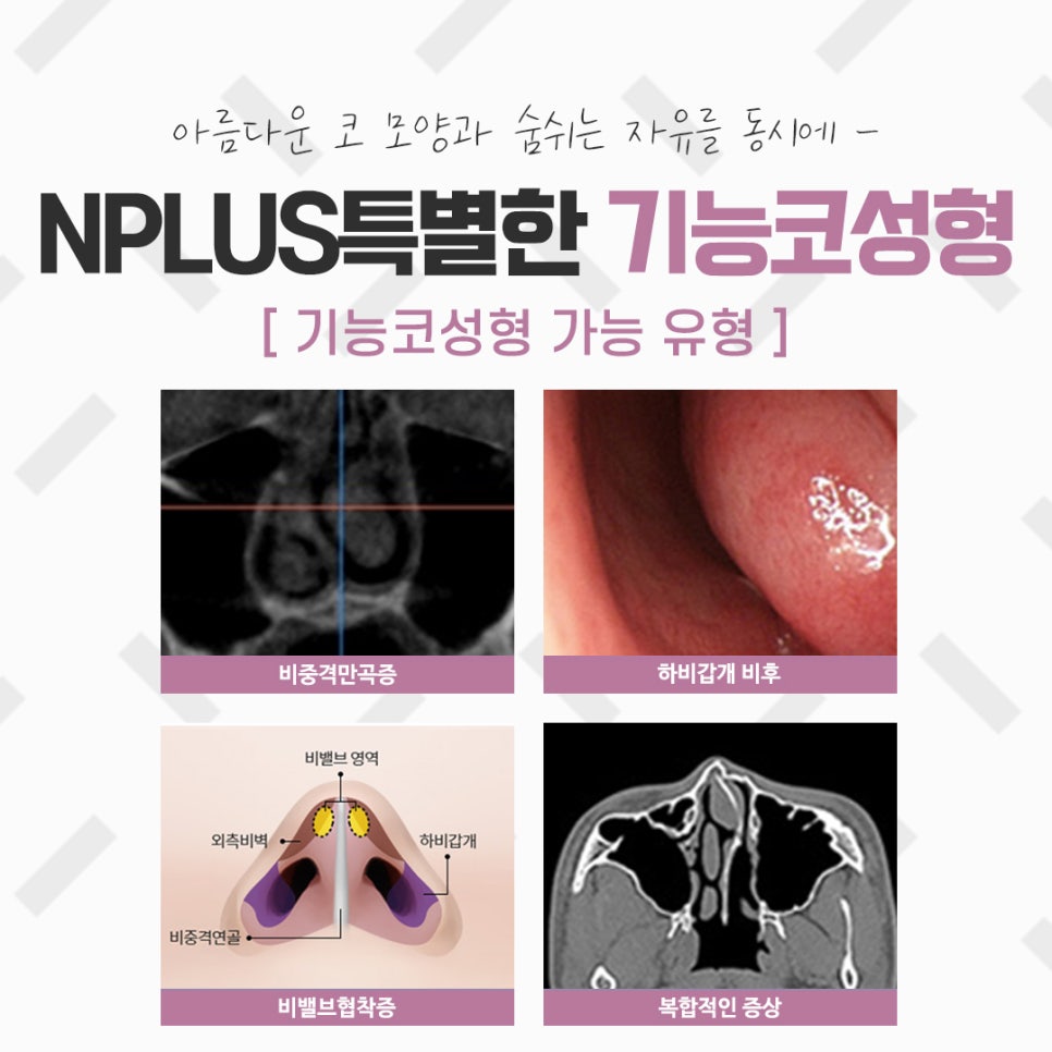 코성형실비를 알아보고 결정 관련 이미지 3
