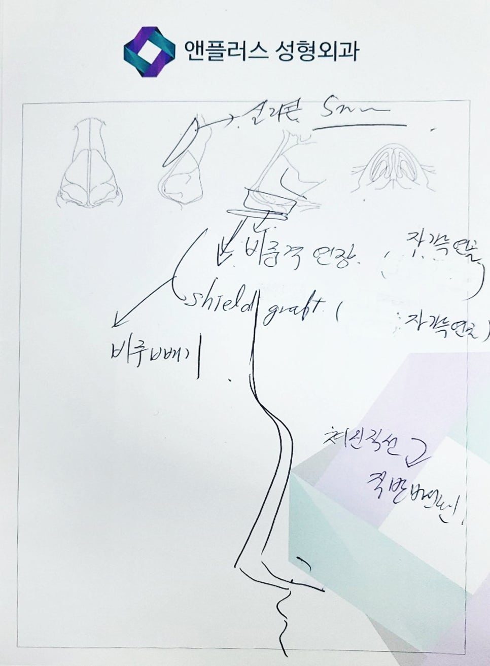 Creating a Straight-But-Slightly-Curved Nose Line with Columella Reduction image 6