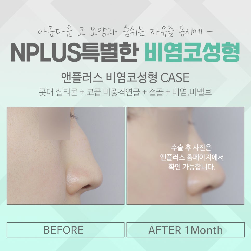 비염수술 내부 진단을 통해 관련 이미지 14