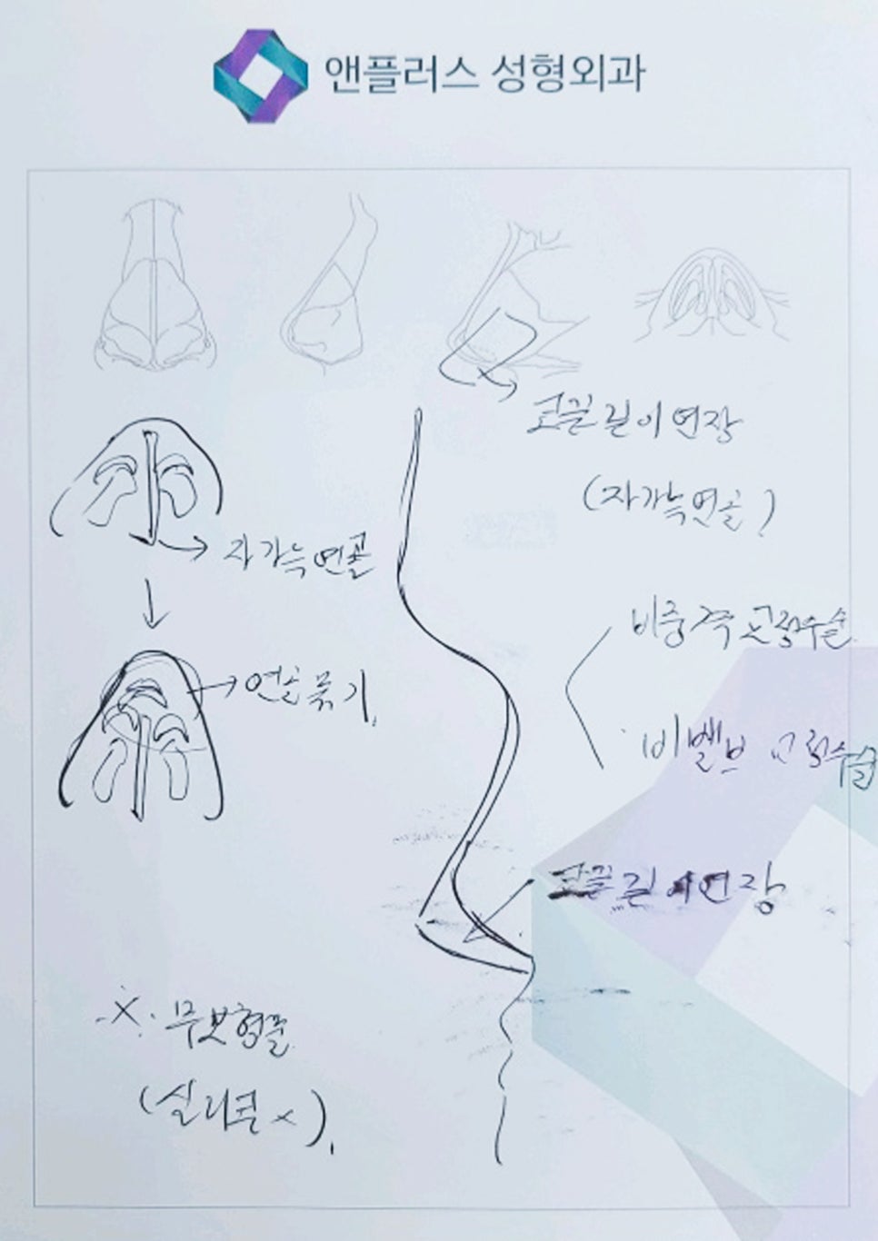Natural and Satisfying Non-Implant Nose Surgery for Men image 8
