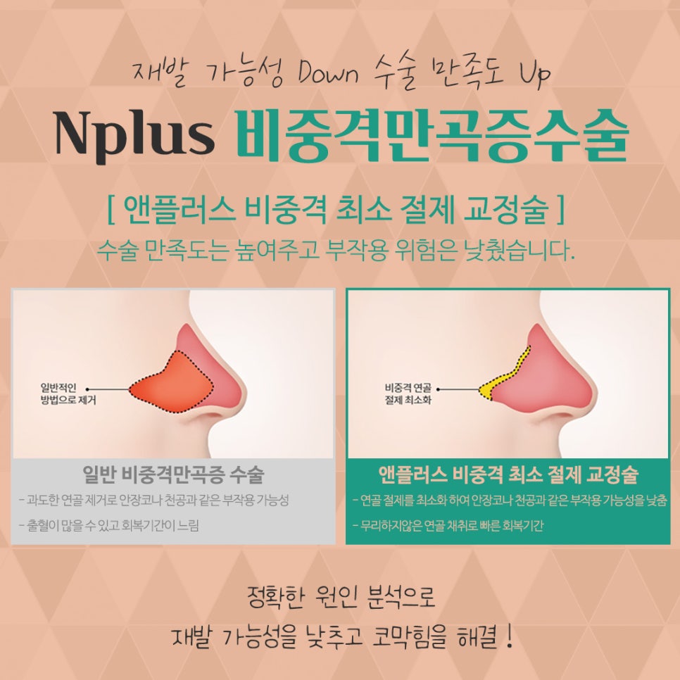 비중격만곡증수술 꼼꼼하게 알아보고 관련 이미지 9