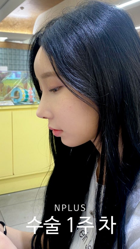 기본코성형후기 절골 + 무보형물 코성형 + 코끝 비중격 연골, 귀 연골 관련 이미지 4
