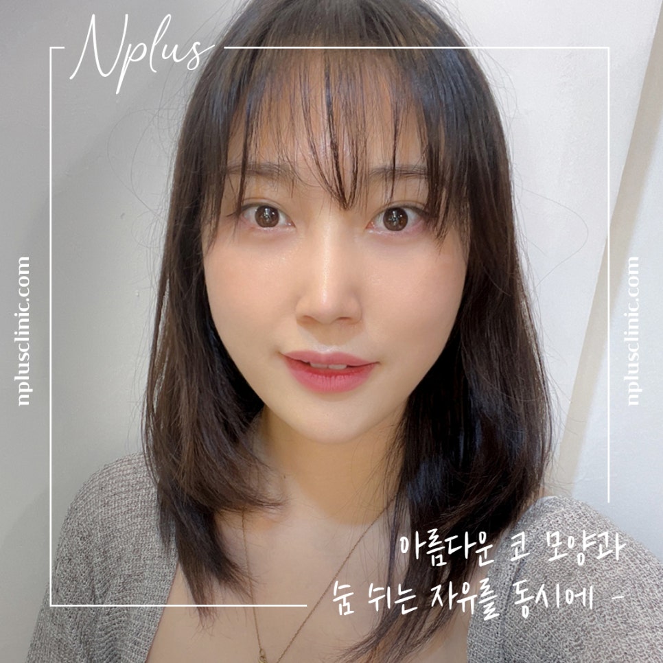 자가늑연골코성형을 통한 이미지 개선 관련 이미지 14