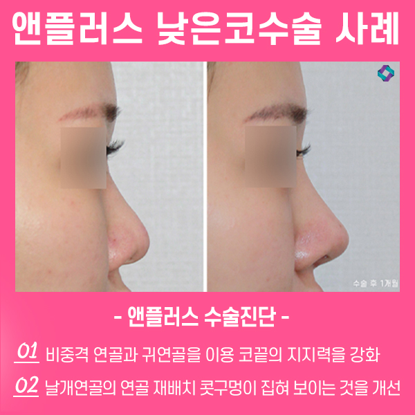 낮은코수술 자연스러운 앤플러스 관련 이미지 1