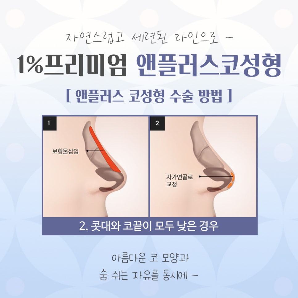 늑연골코성형을 고민한다면 관련 이미지 8