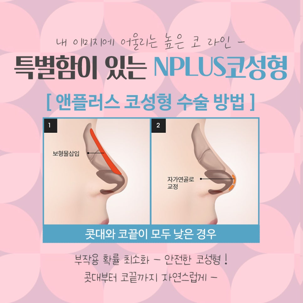 Nose Surgery Review with a Natural Nose Line image 8