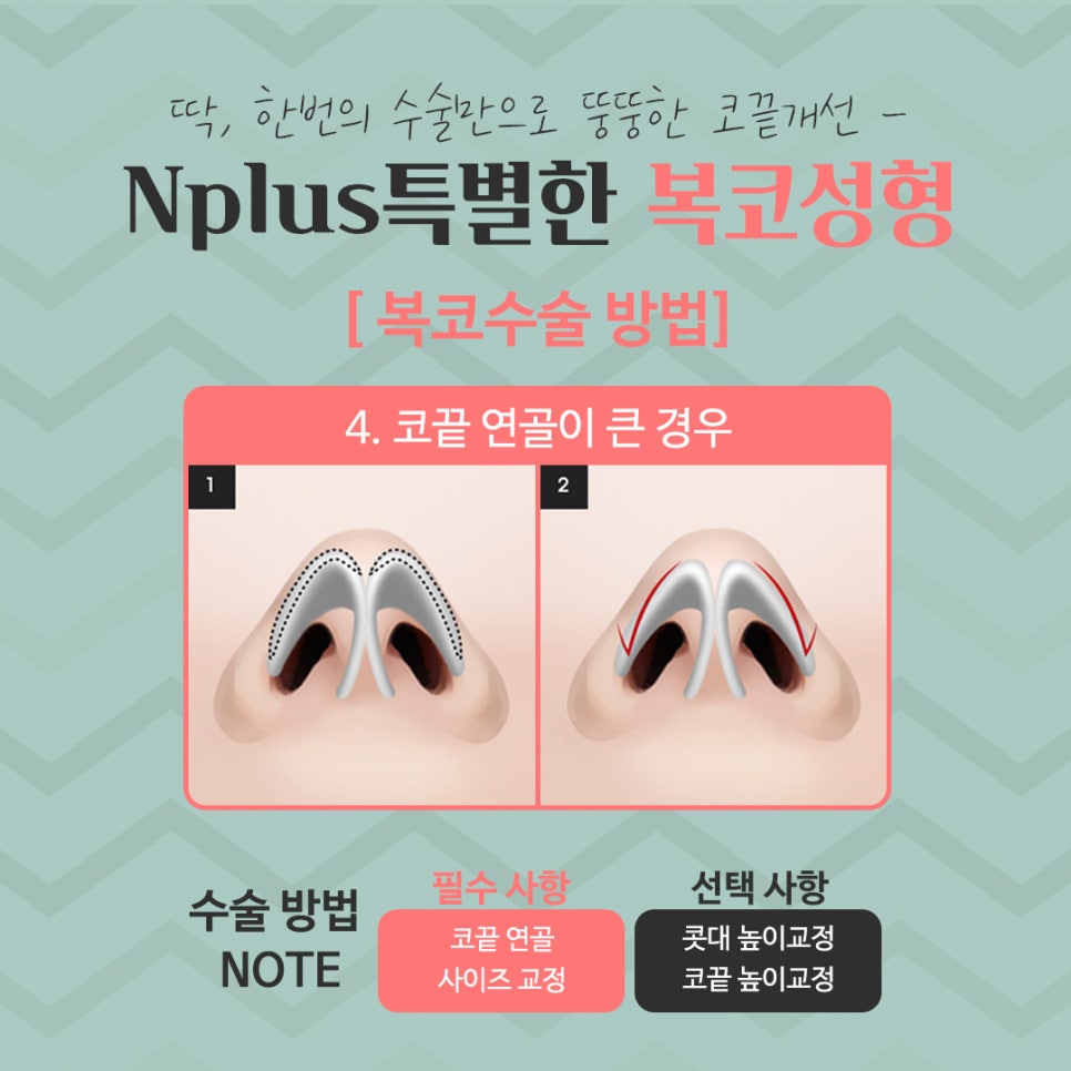 복코수술후기 세련된 인상으로 관련 이미지 11