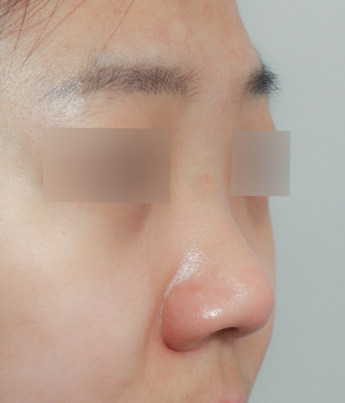 낮은코성형 비염수술도 예쁘게 관련 이미지 7