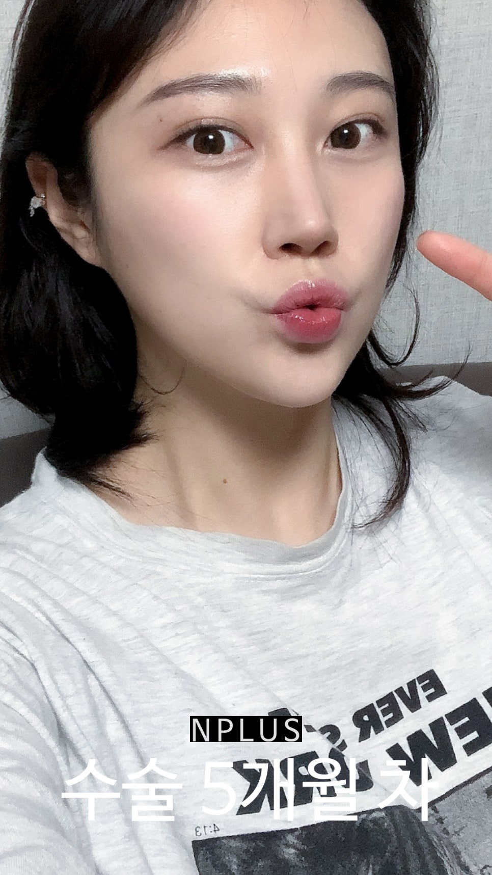 앤플러스에서 진행된 매부리코성형후기 관련 이미지 10