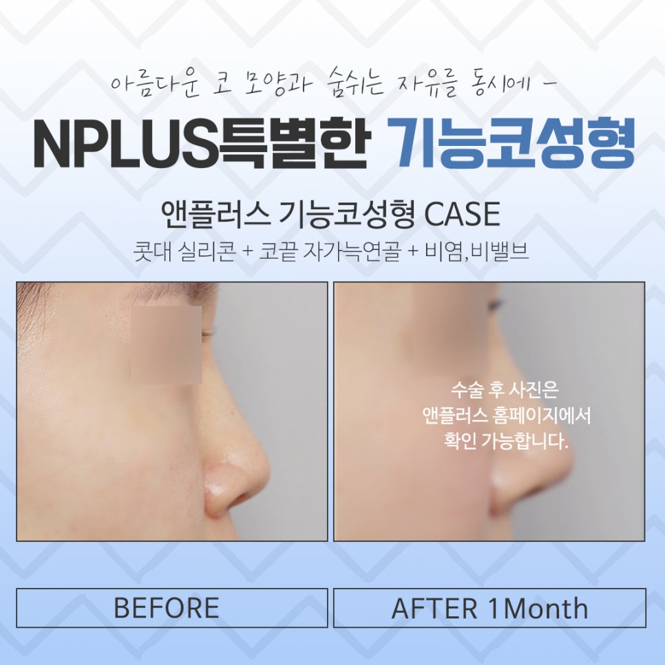 비염수술전후 확실한 차이를 알아보고 관련 이미지 15