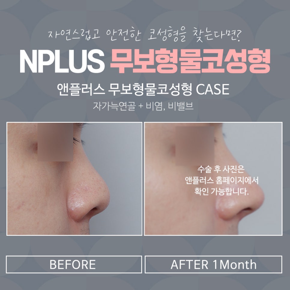 No-Implant Nose Surgery for a Natural Nose Line image 4