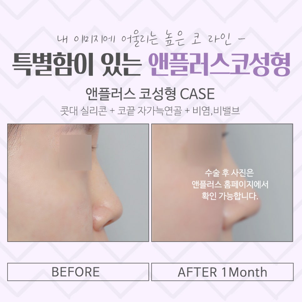 코수술후기를 통해 내게 어울리는 라인으로 관련 이미지 15