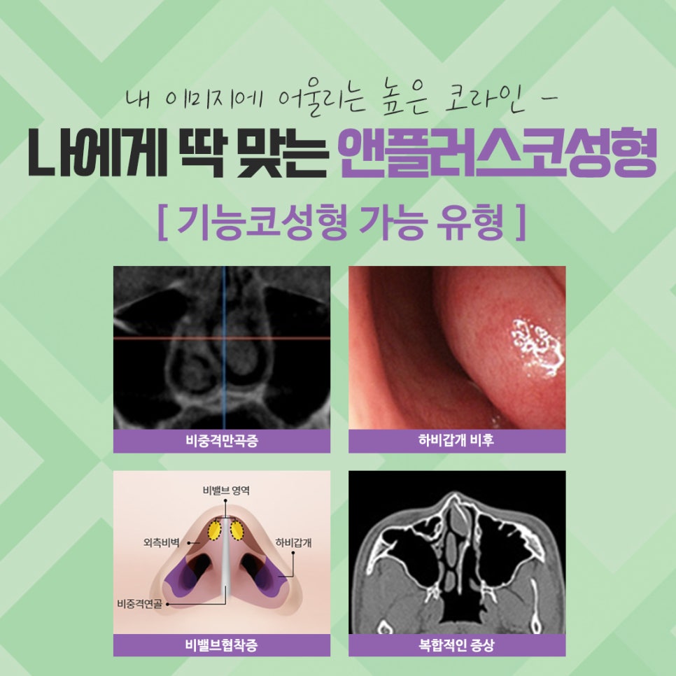 Check the Difference Before and After Rhinoplasty image 5