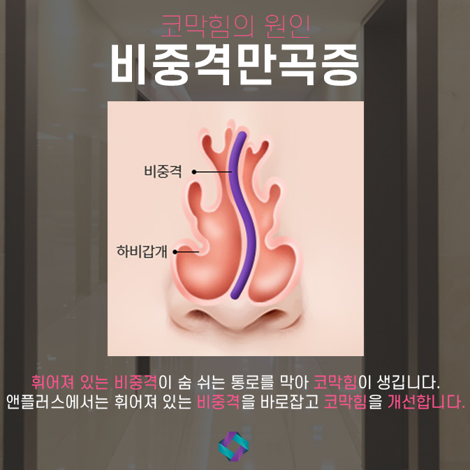 낮은코수술 자연스러운 앤플러스 관련 이미지 8