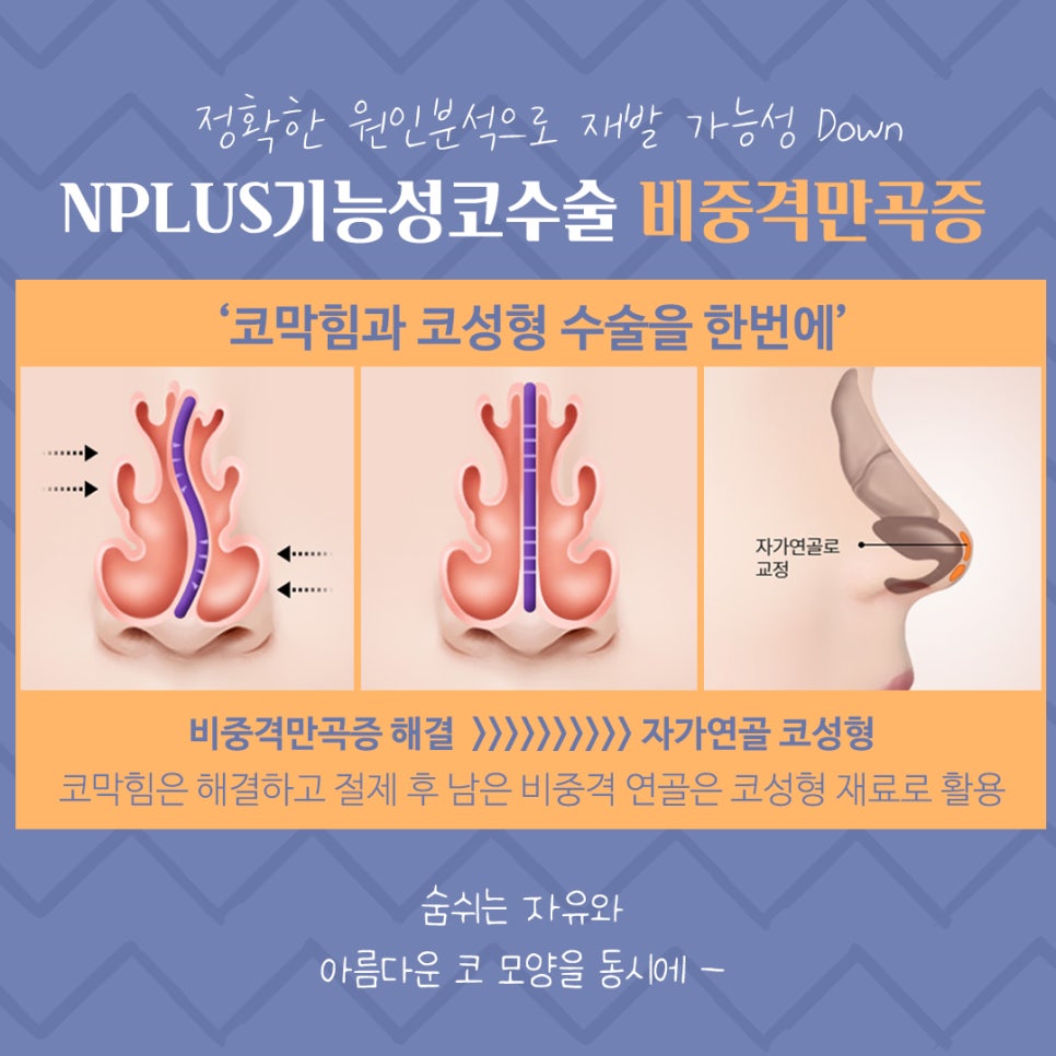 비중격만곡증수술 후기까지 꼼꼼하게 알아보고 관련 이미지 7