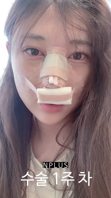 앤플러스에서 진행된 매부리코성형후기 관련 이미지 3