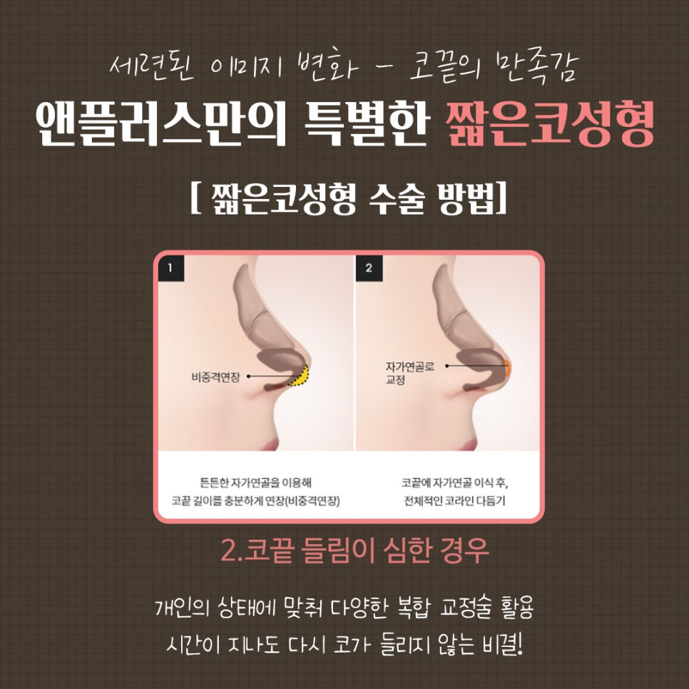 들창코수술후기 튼튼한 비주지지대 관련 이미지 9