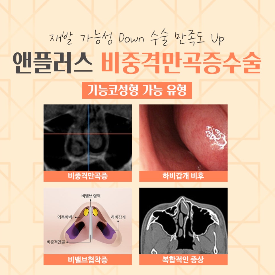 비중격만곡증수술후기 코 내부를 정확하게 파악해야 관련 이미지 5