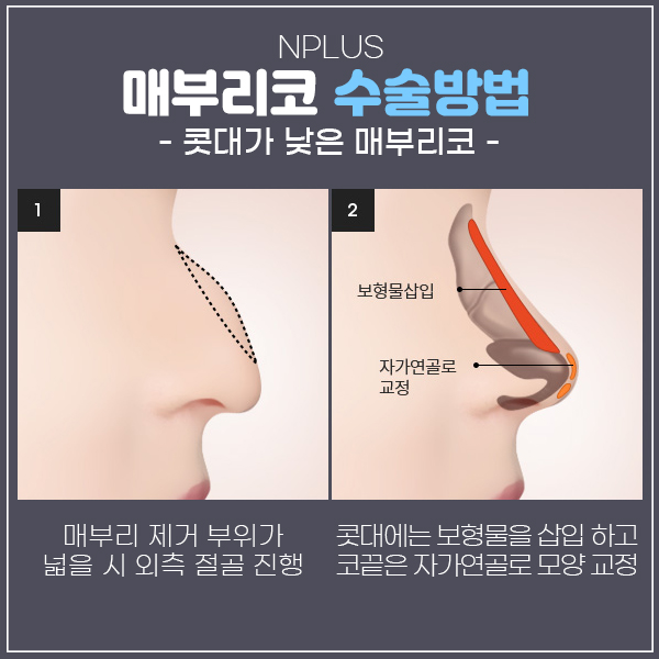 Improving Both the Function and Appearance of a Hump Nose in Men image 6