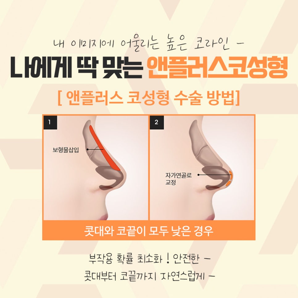 자가연골코수술을 통한 이미지 개선 관련 이미지 8