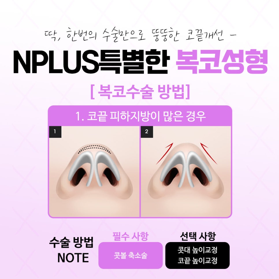 복코수술후기 날렵하고 세련된 라인으로 관련 이미지 7