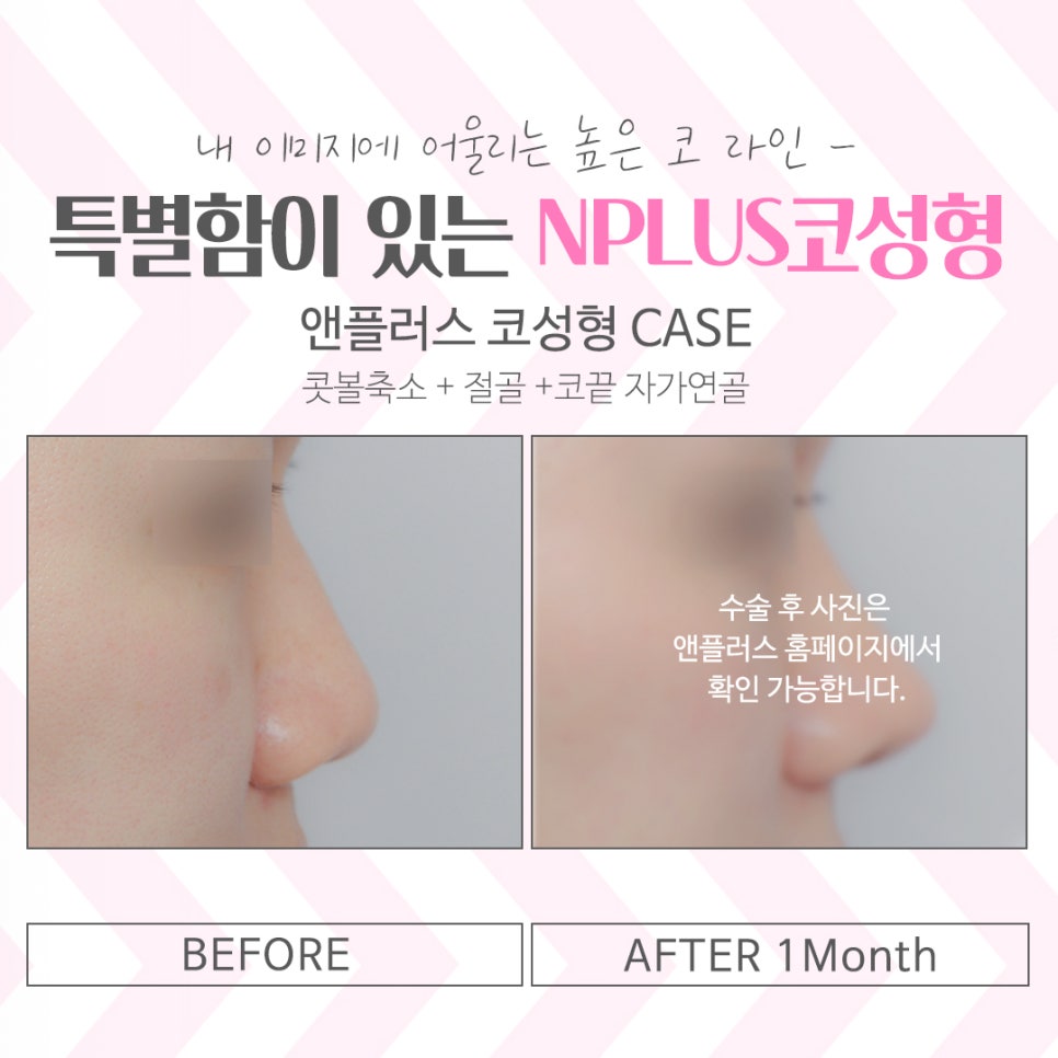 코성형잘하는곳 여러 가지를 고려하여 관련 이미지 14