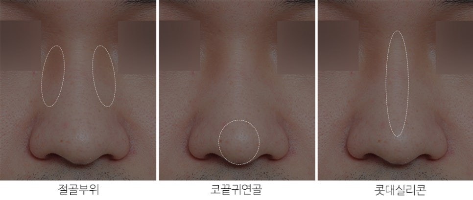 남자 복코와 매부리코 수술 후기 관련 이미지 3
