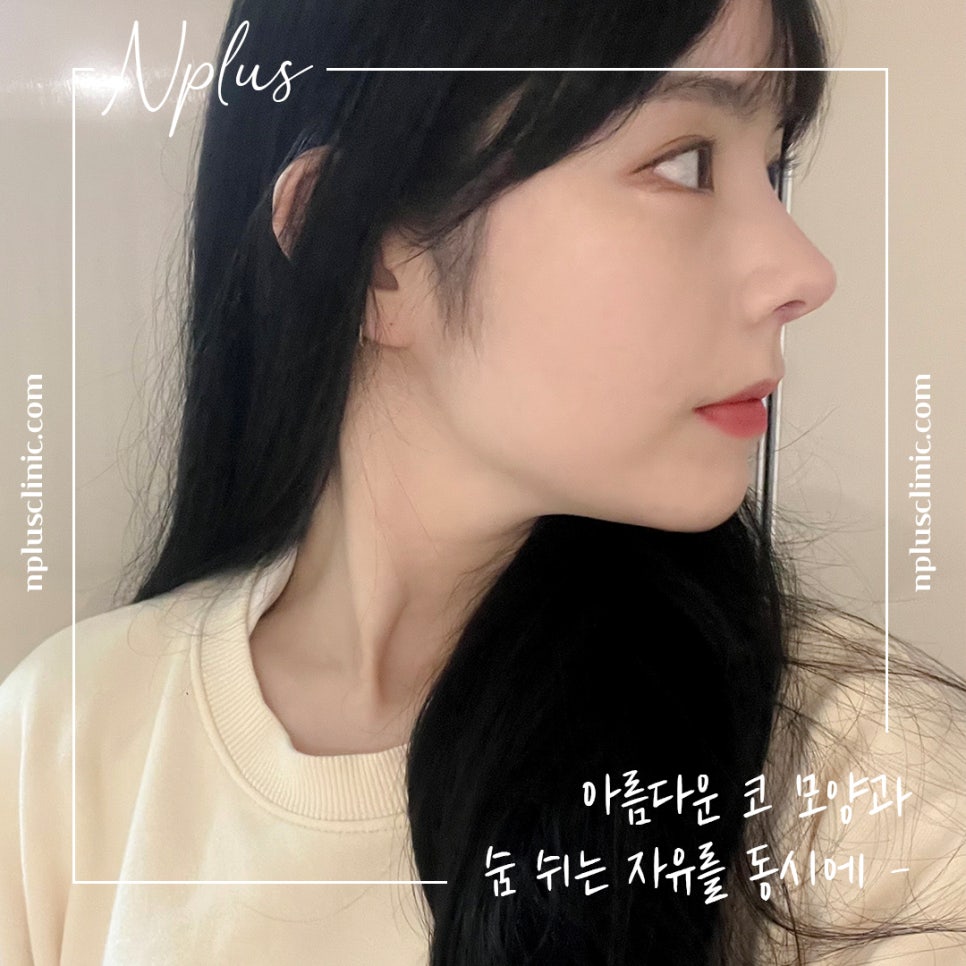 Accurately Reviewing Rhinoplasty Experience image 1