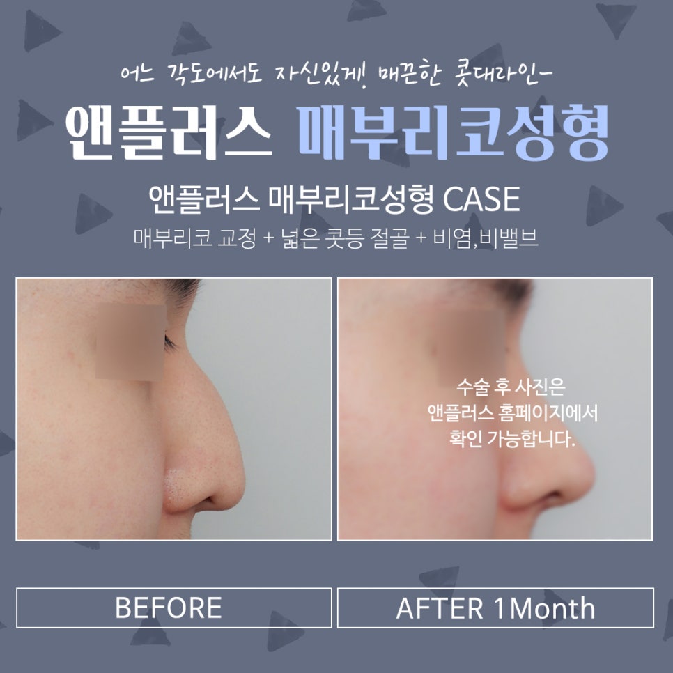 남자매부리코성형 기능까지 고려해서 관련 이미지 11