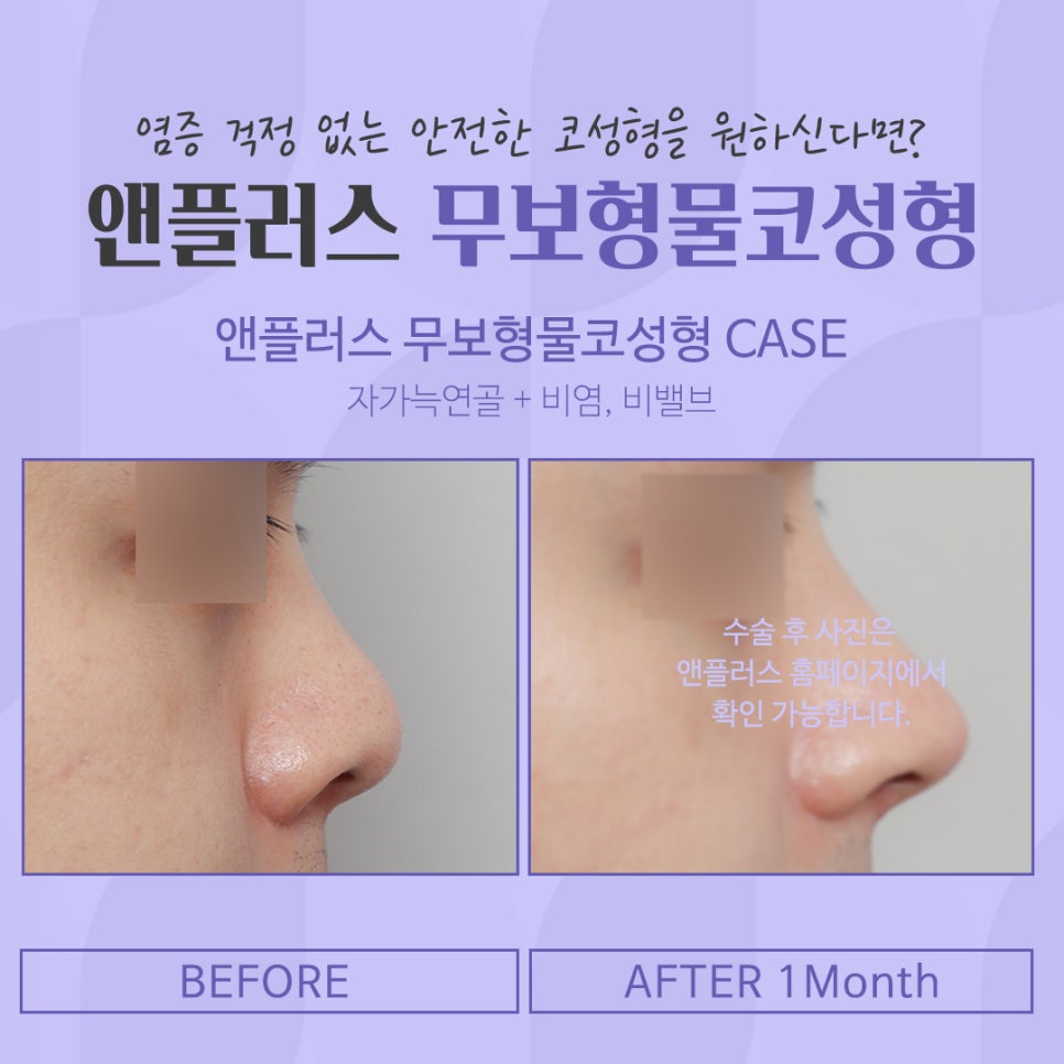 무보형물코성형 자가연골 활용으로 안전하게 관련 이미지 12