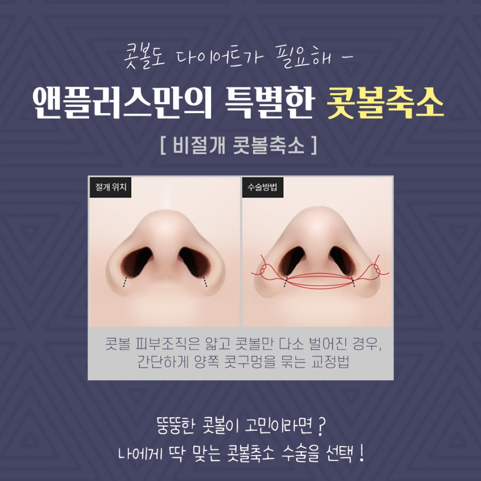 Non-Scar Alar Reduction to Improve a Bulbous Nose image 6