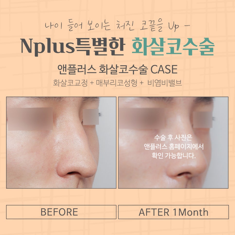 화살코수술 후기까지 알아보고 결정 관련 이미지 17