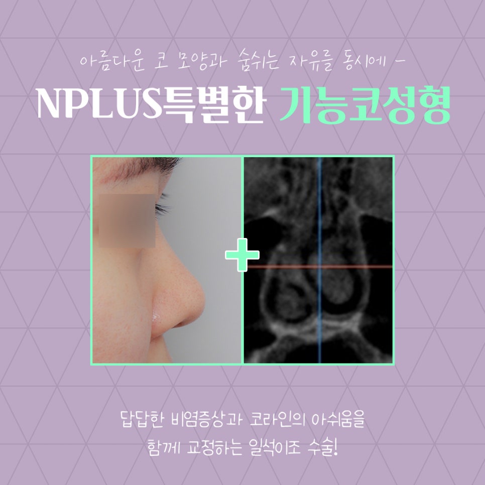 앤플러스의원에서 알려드리는 기능코성형 관련 이미지 4