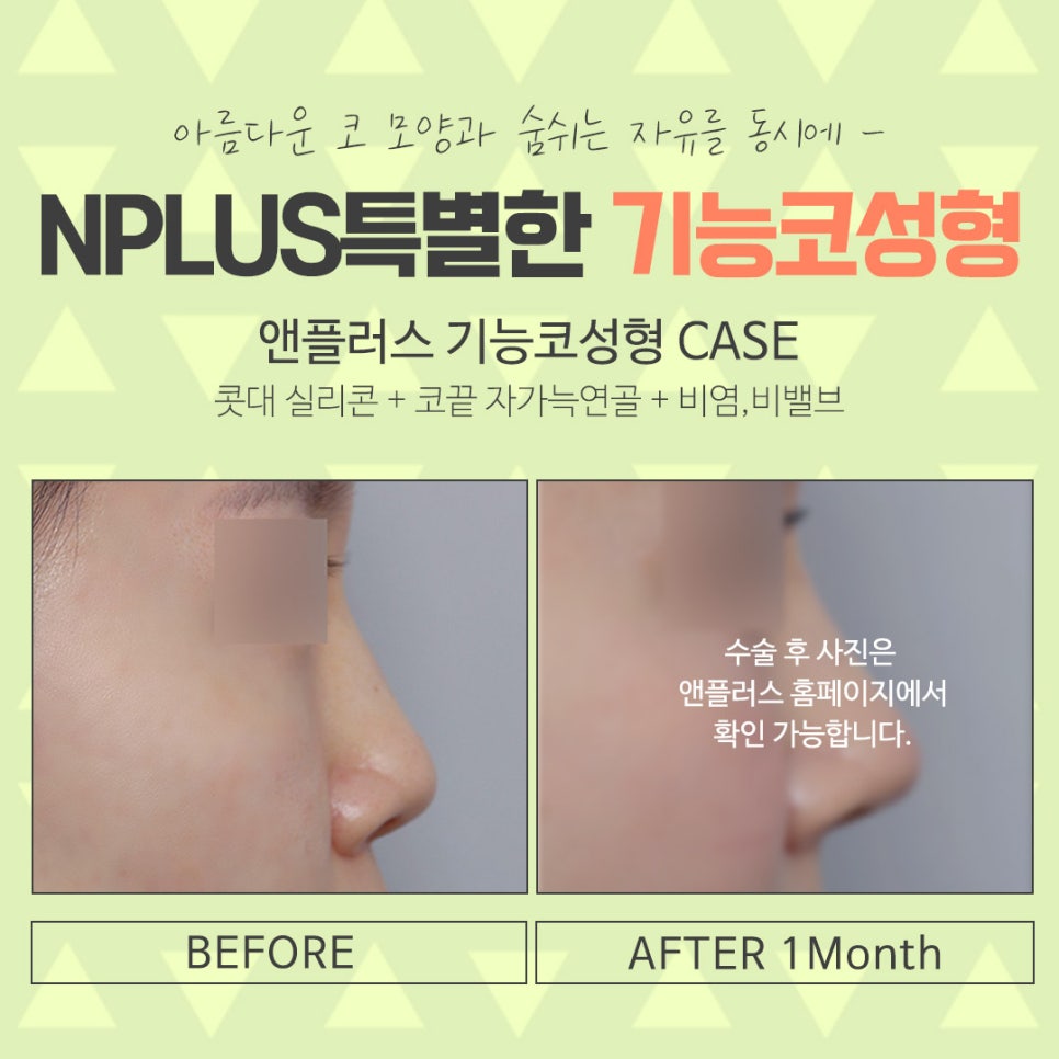 코성형보험에 대해 정확하게 알아보고 관련 이미지 7