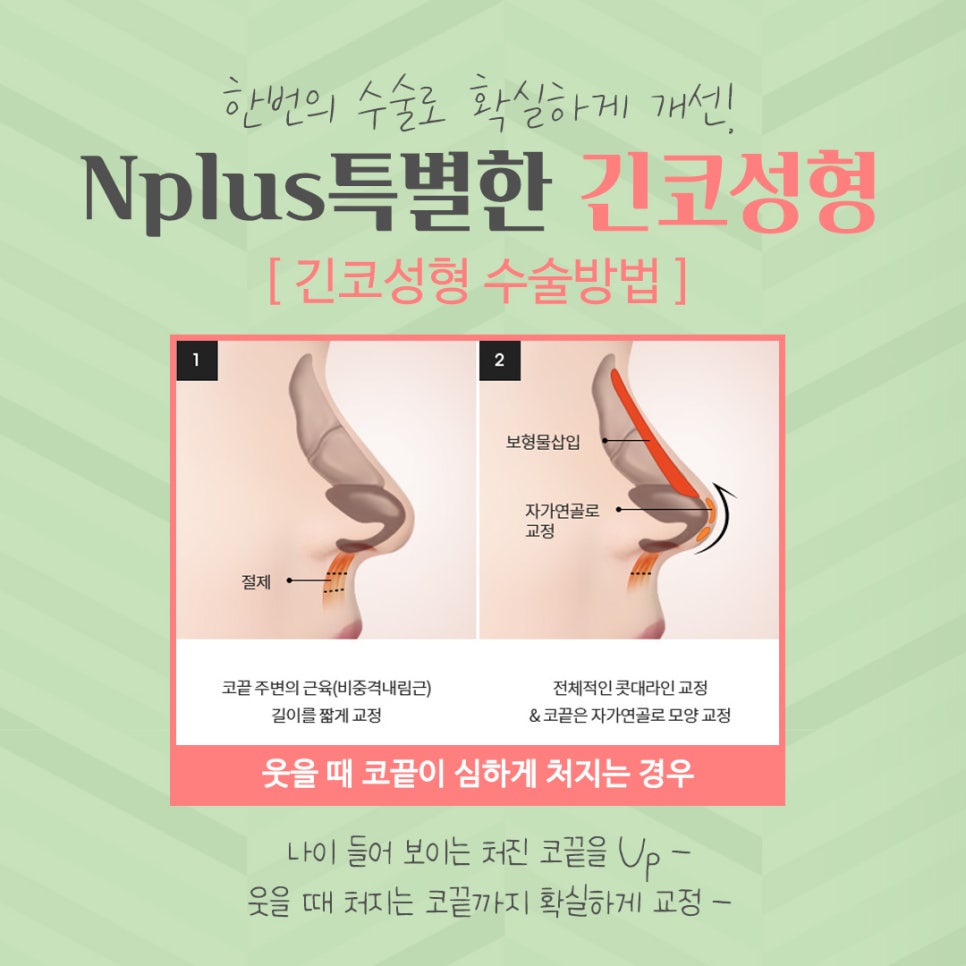 Long Nose Surgery: From Looking Older to Looking Younger image 9