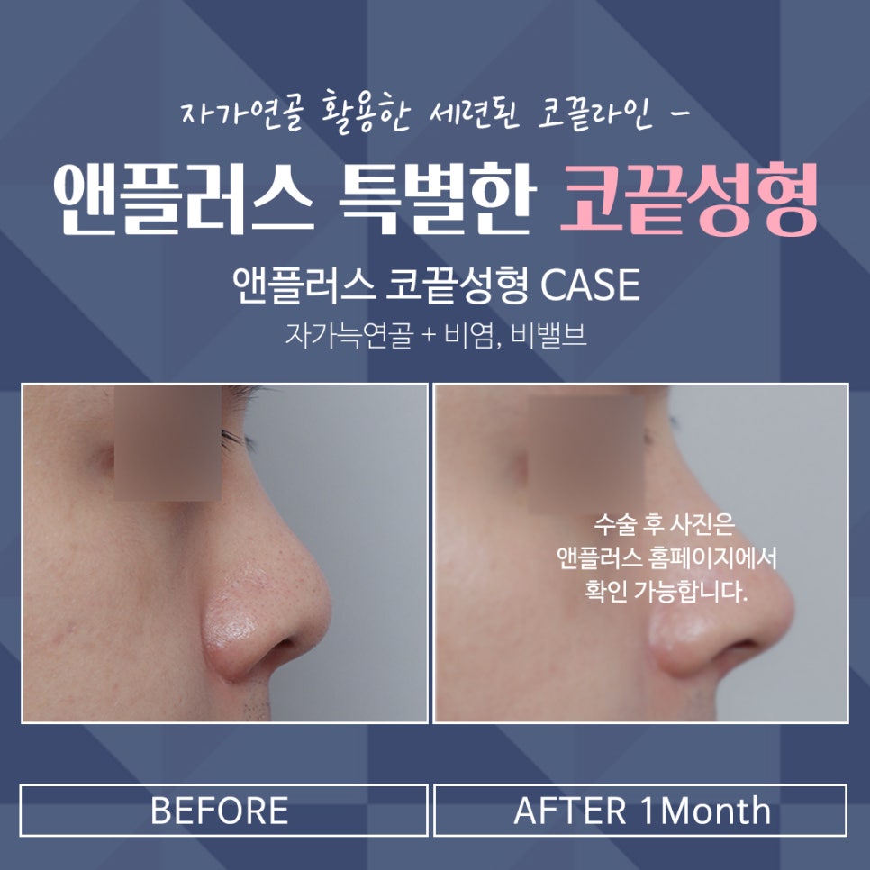 Nose Tip Surgery Review Using Tip Cartilage Suturing image 7