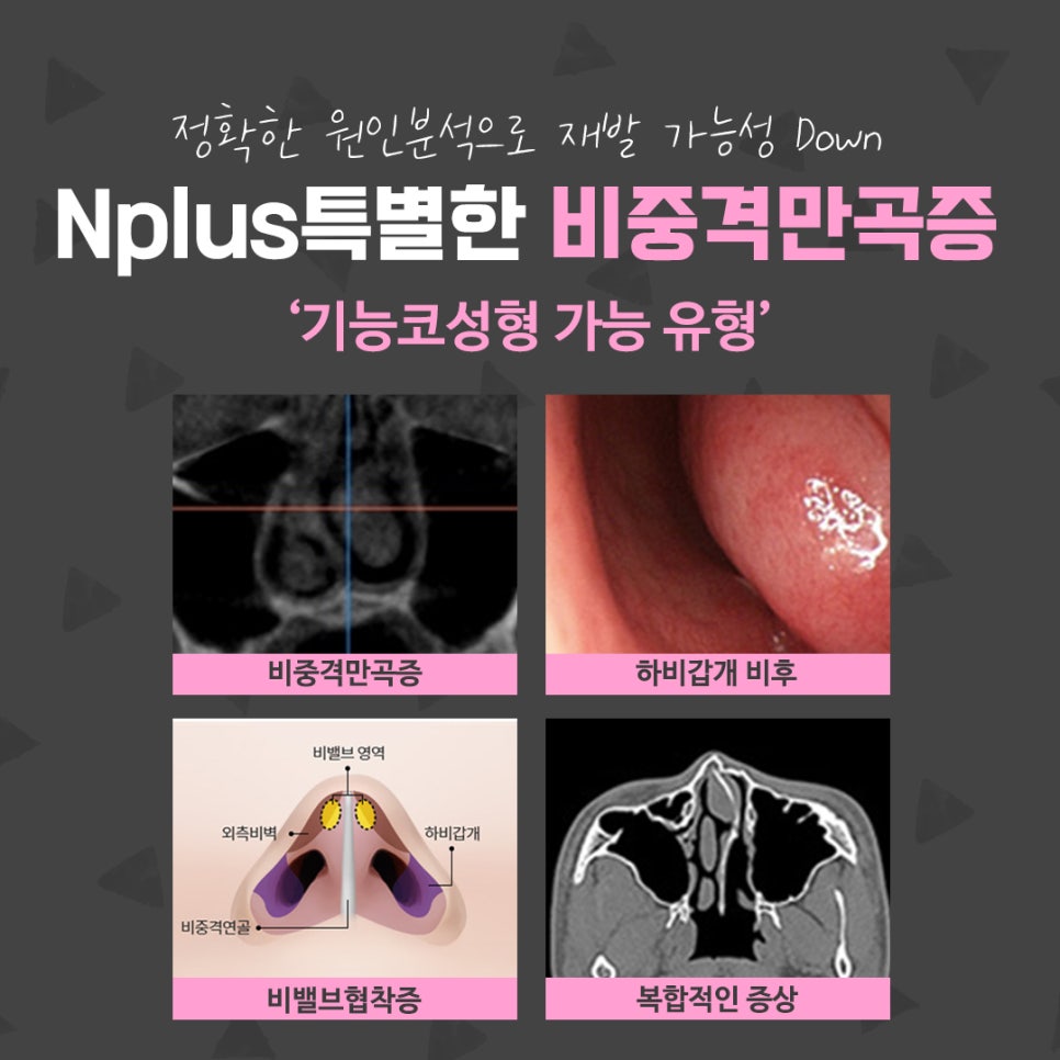 비중격만곡증수술 신중한 선택으로 관련 이미지 6