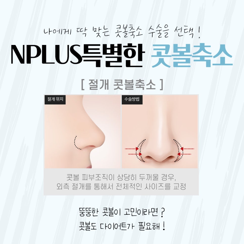 Natural Progress in Nasal Alar Reduction Surgery Review image 9