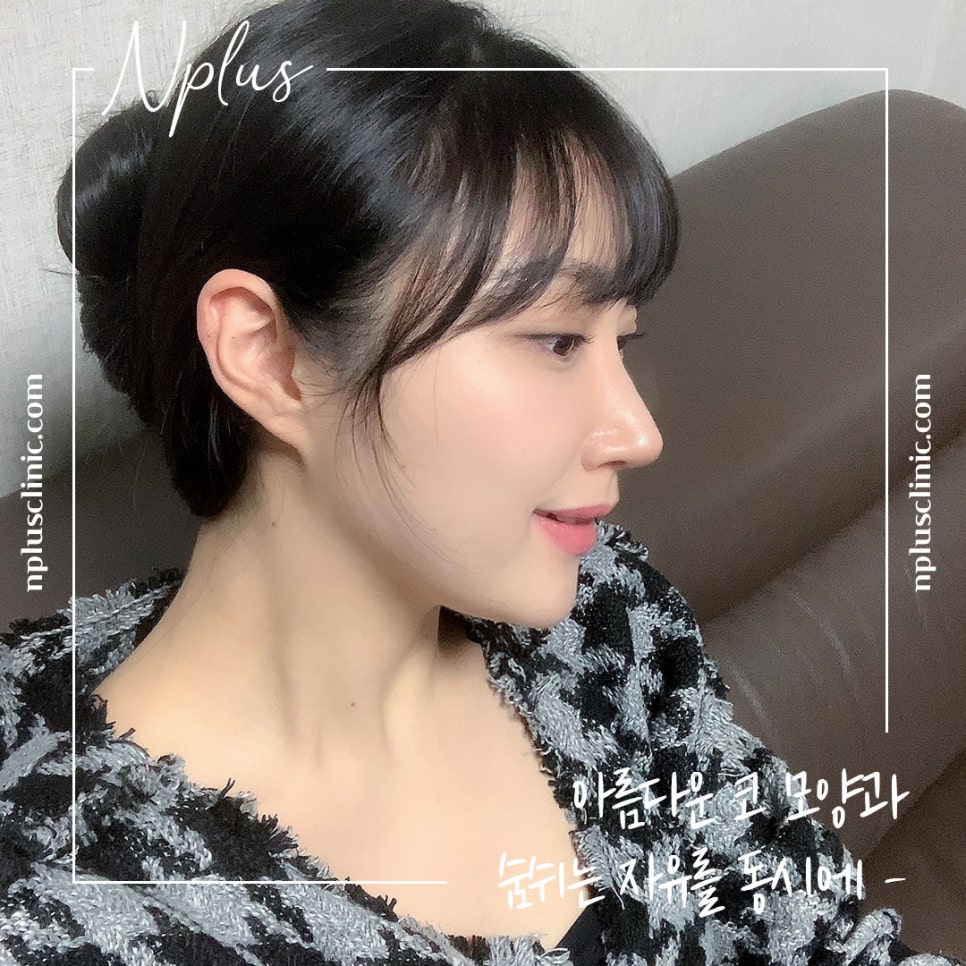 Reviewing Nostril Reduction Results and Improving Your Appearance image 1