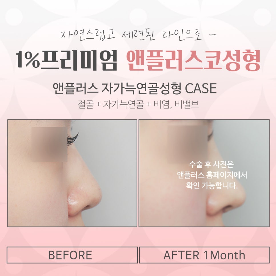 늑연골코수술을 통해 세련된 라인으로 관련 이미지 15