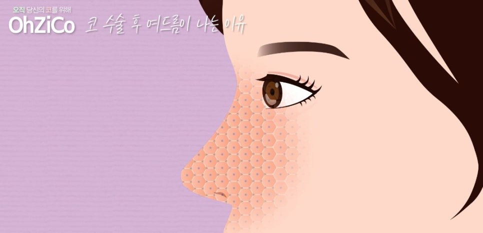코수술후 코여드름 원인과 해결 방법 관련 이미지 6